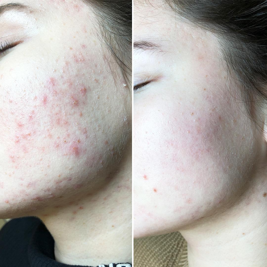 Дерматолог- лікування акне Київ