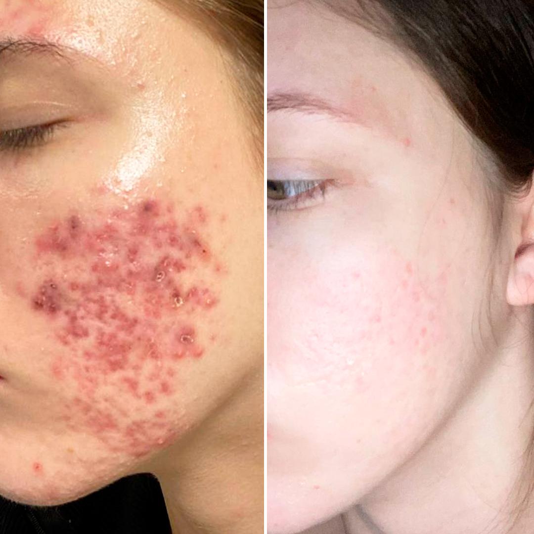 Лікування акне Київ