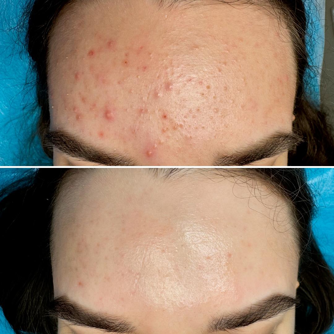 Результат лікування акне Київ
