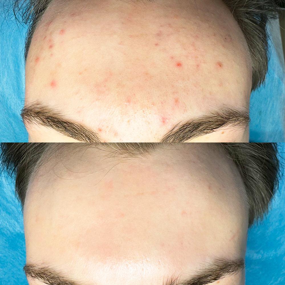 Лікування акне в Києві