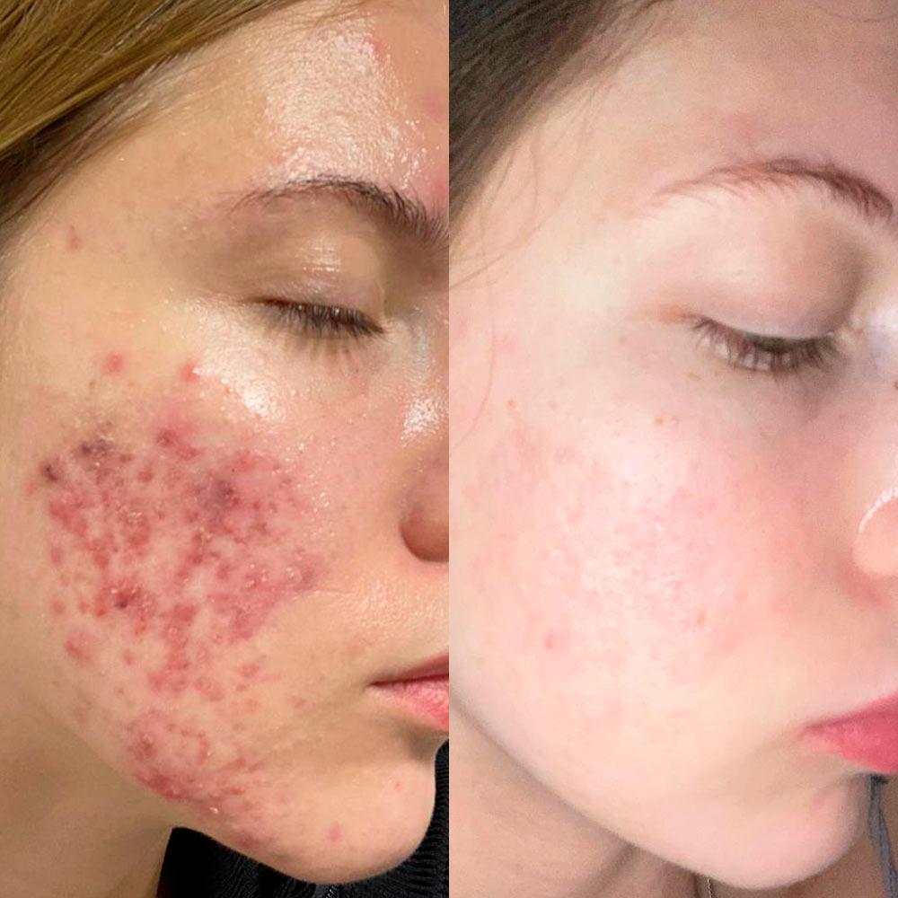 Лікування акне Київ