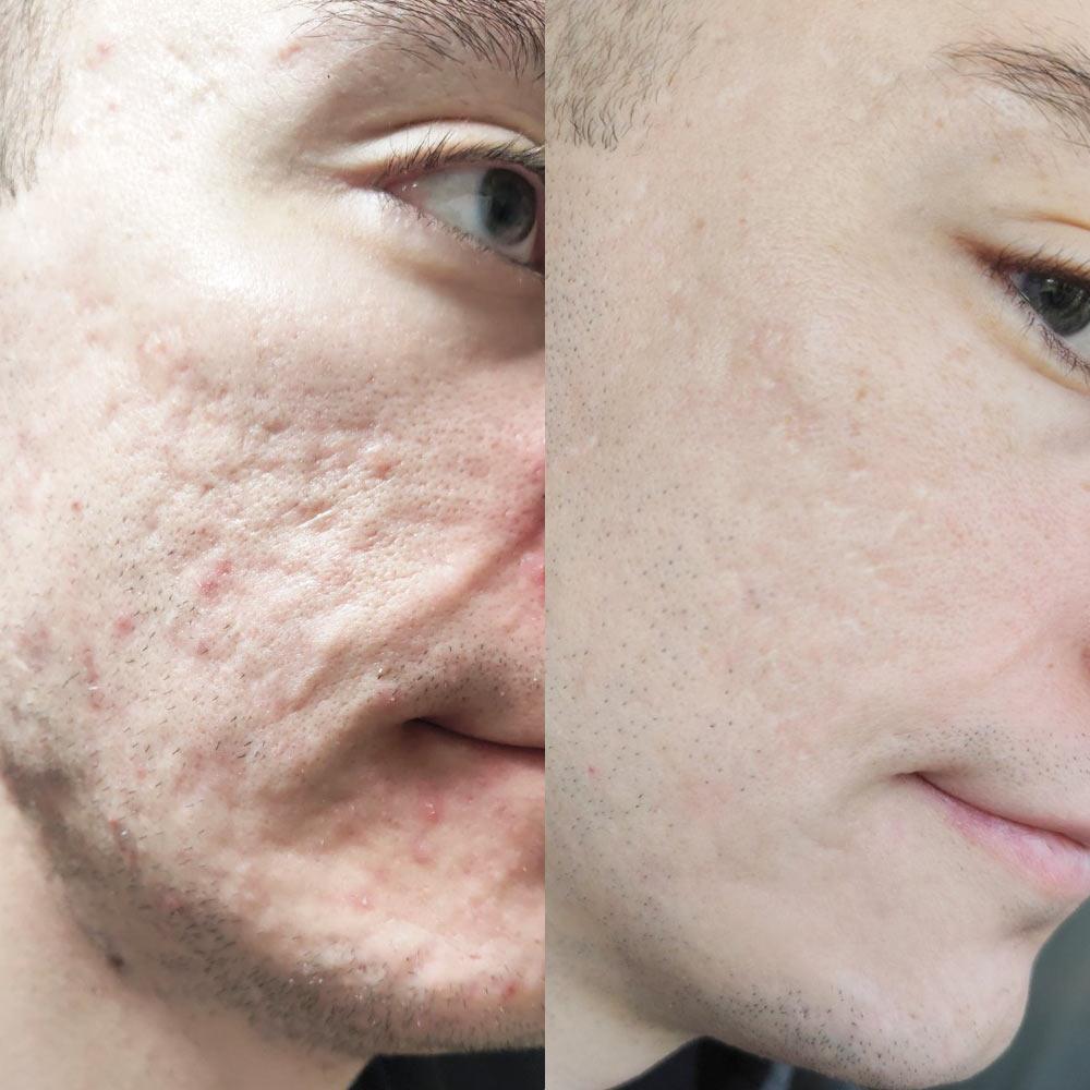 Лікування акне Київ