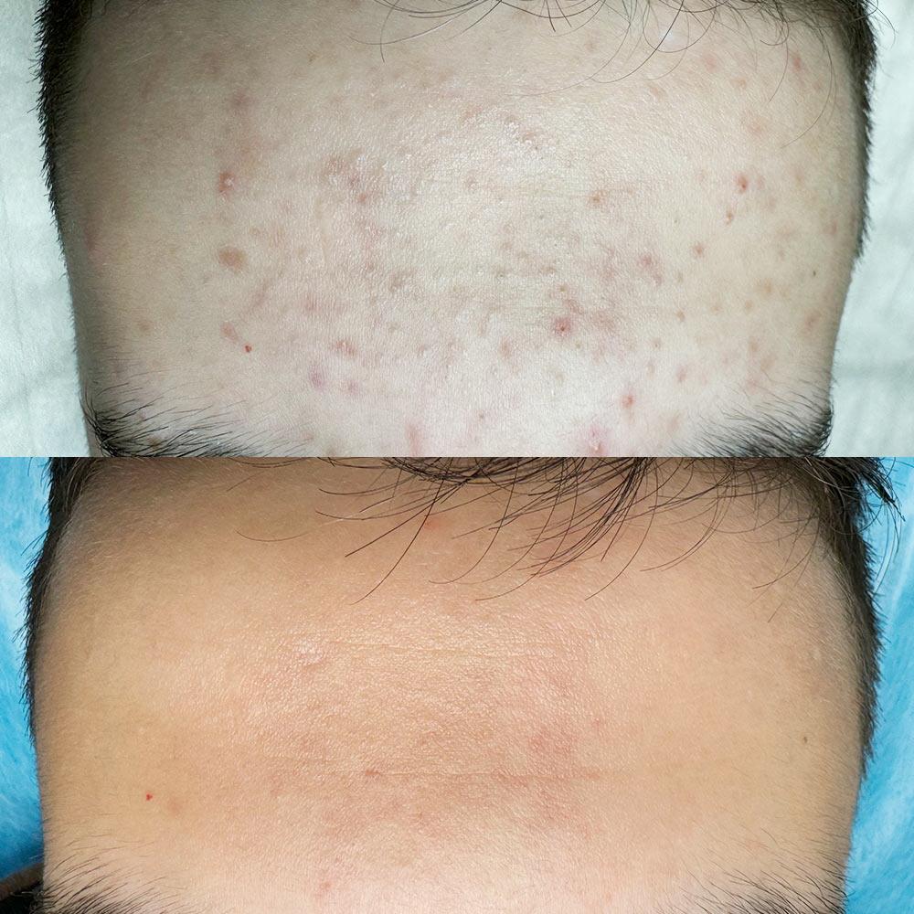 Лікування проблемної шкіри Київ