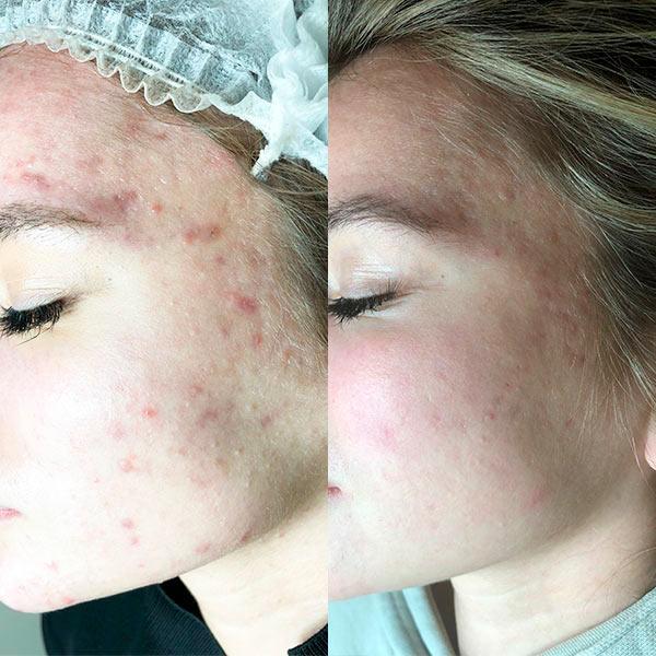 Дерматолог - лікування акне Київ