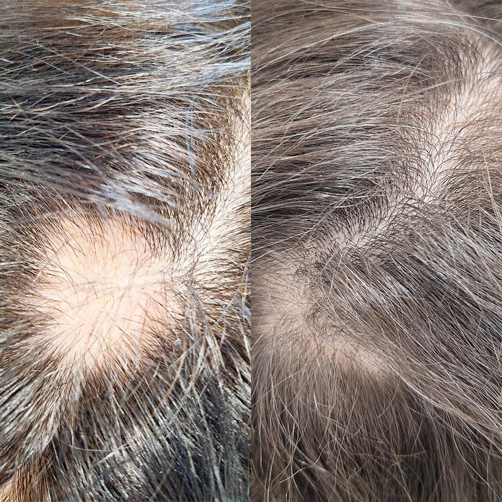 Лікування вогнищевої алопеції Київ Лікування вогнищевої алопеції Київ