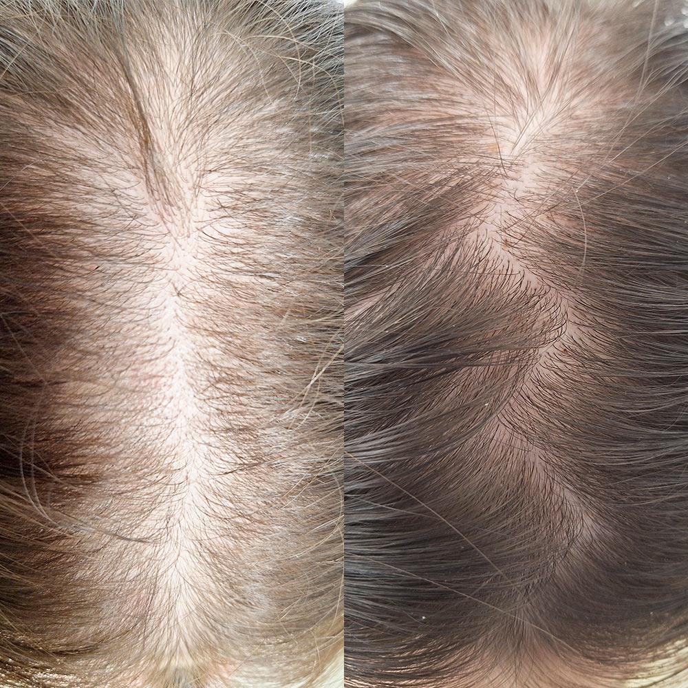 Лікування хронічного телогенового випадіння волосся Київ Лікування хронічного телогенового випадіння волосся Київ