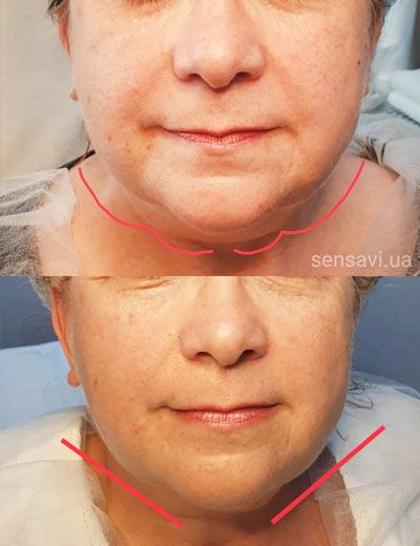 Ліполітики