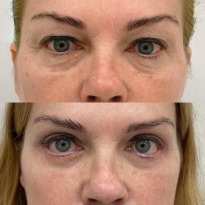 Пластика верхніх та нижніх повік Київ