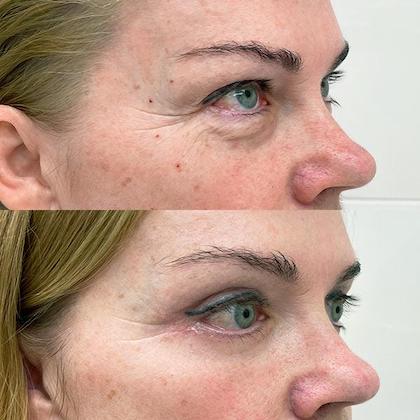 Блефаропластика повік Київ