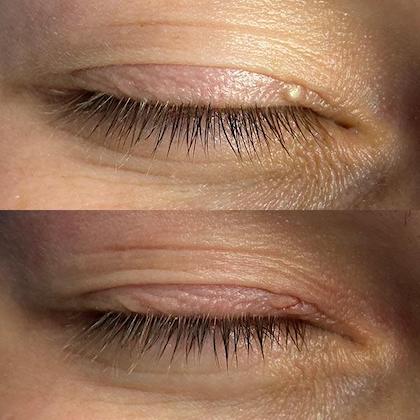 Видалення новоутворення на пивіці Київ Видалення новоутворення на пивіці Київ