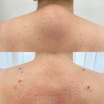 Видалення вдовиного горба Київ