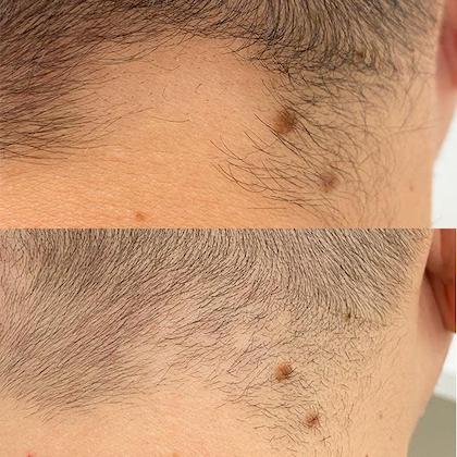 Лікування алопеції Київ