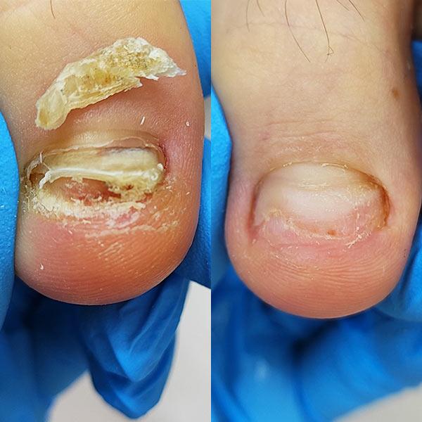 Обработка грибковых ногтей Киев Обработка грибковых ногтей Киев