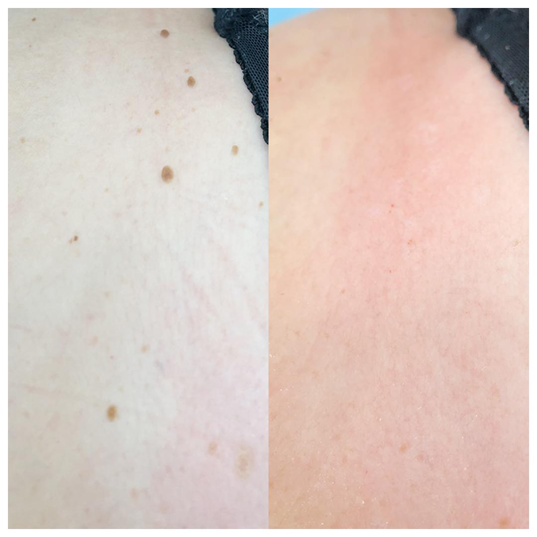 удаление родинок на теле Киев