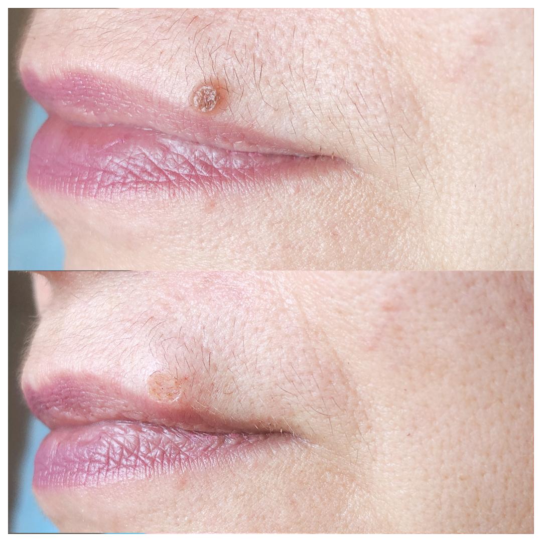 удаление родинки лазером на лице