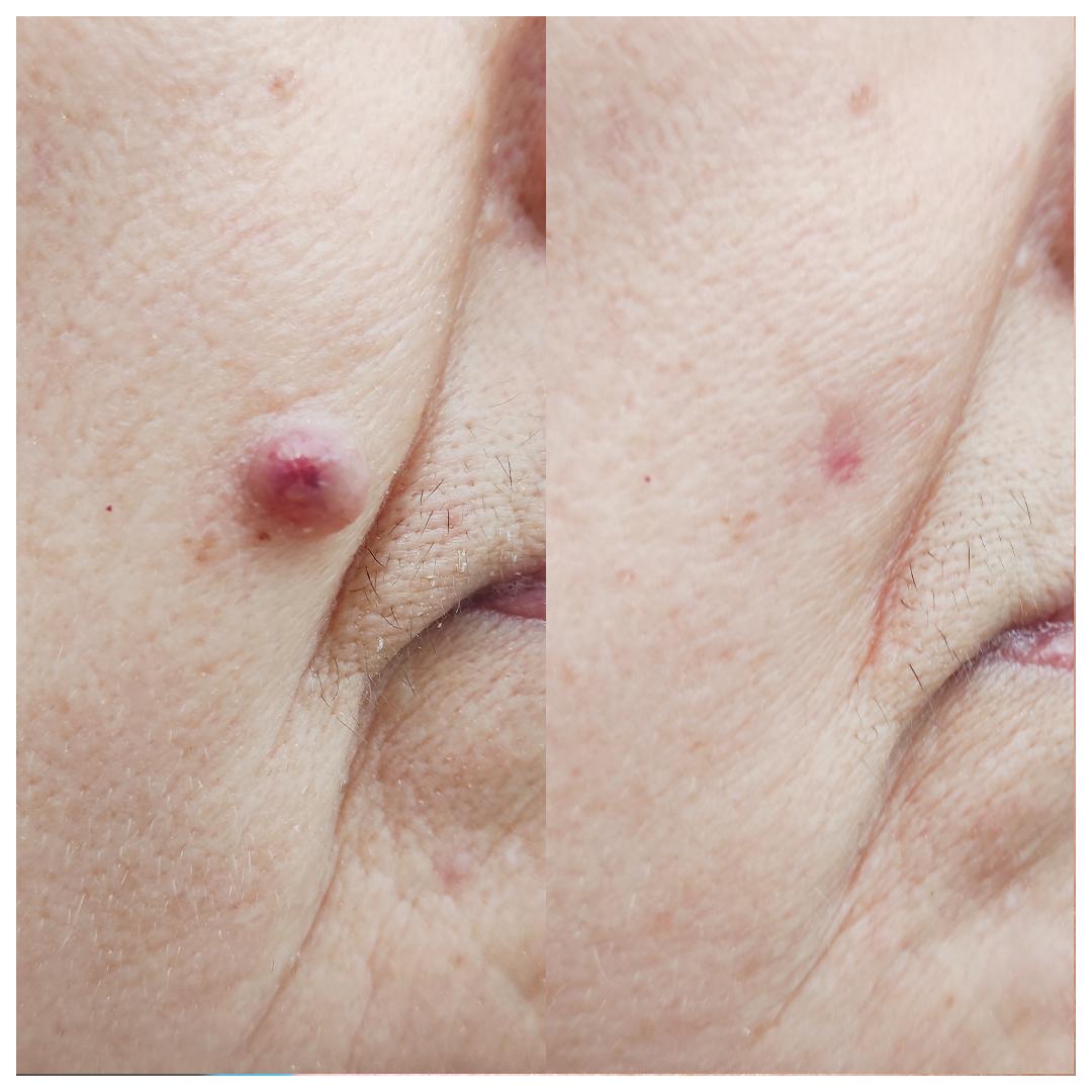 видалення  родимок на обличчі