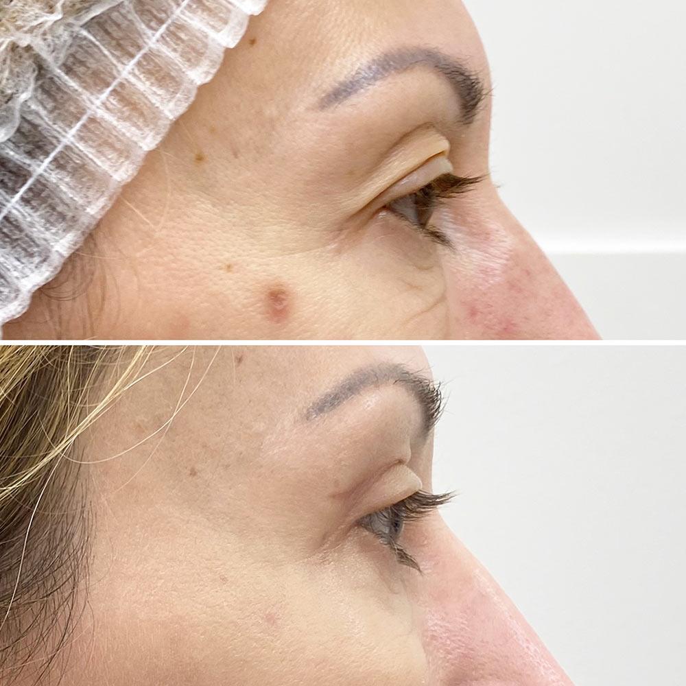 Верхняя Блефаропластика Киев