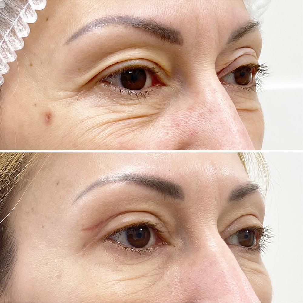 Блефаропластика верхніх повік Київ