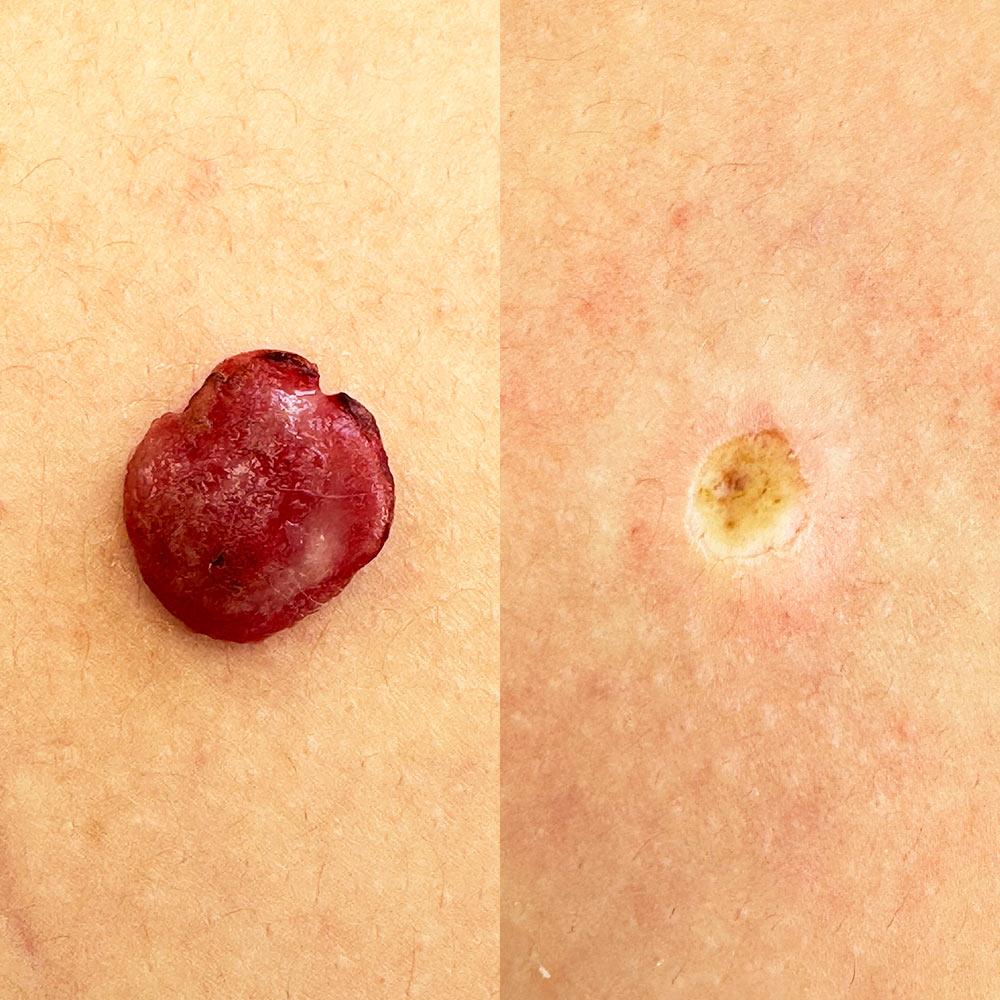 Радиоволновое удаление гемангиомы Киев Радиоволновое удаление гемангиомы Киев