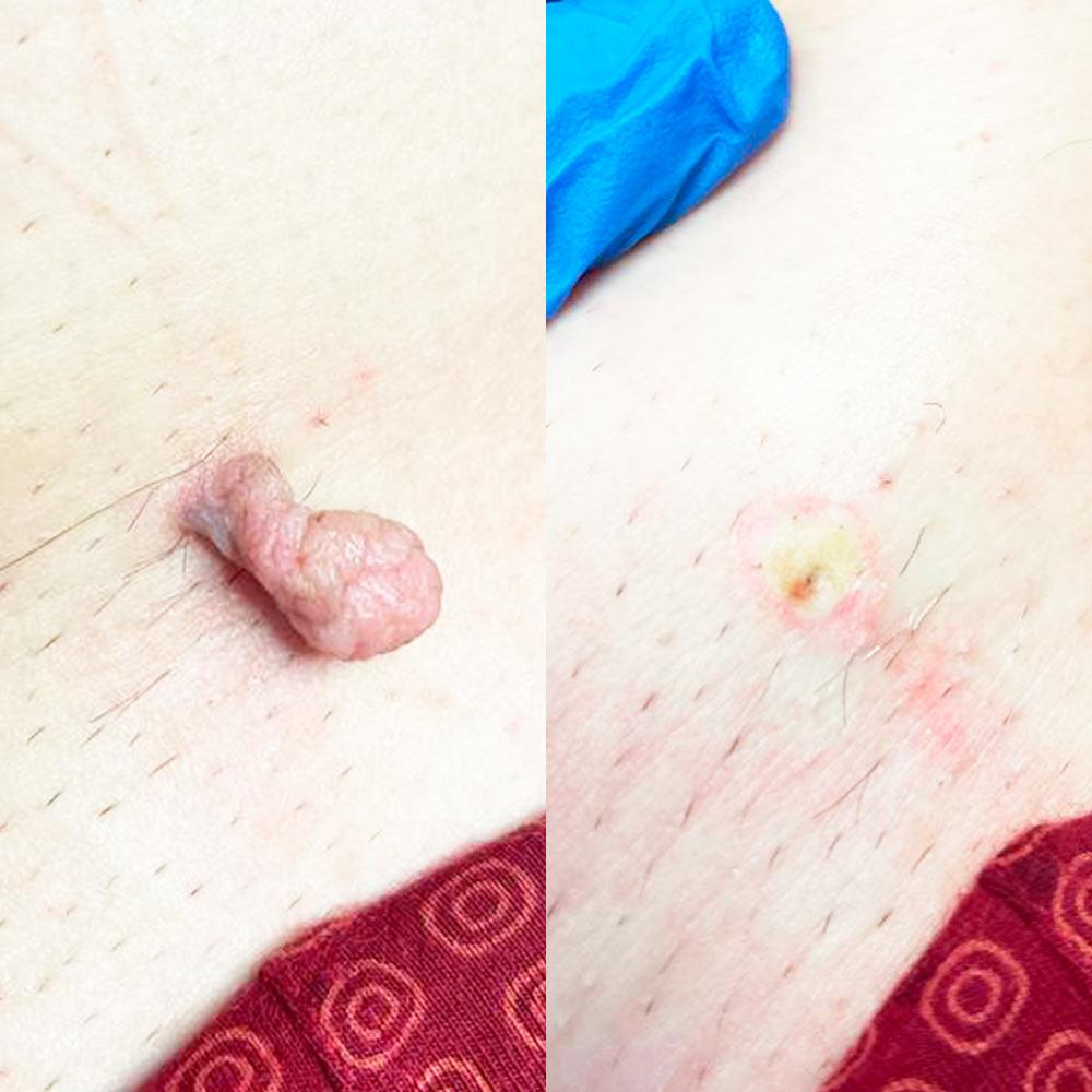 Радіохвильове видалення папіломи Київ