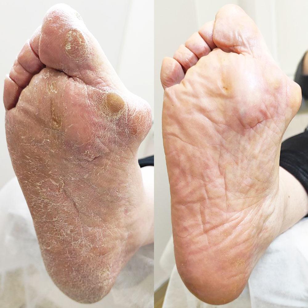 Педикюр для діабетичної стопи Київ