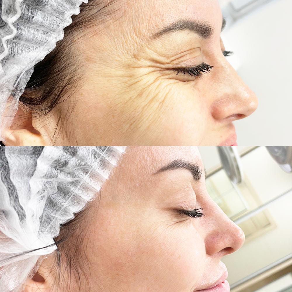 Диспорт мімічні зморшки навколо очей – лікар косметолог Губатюк В.А.