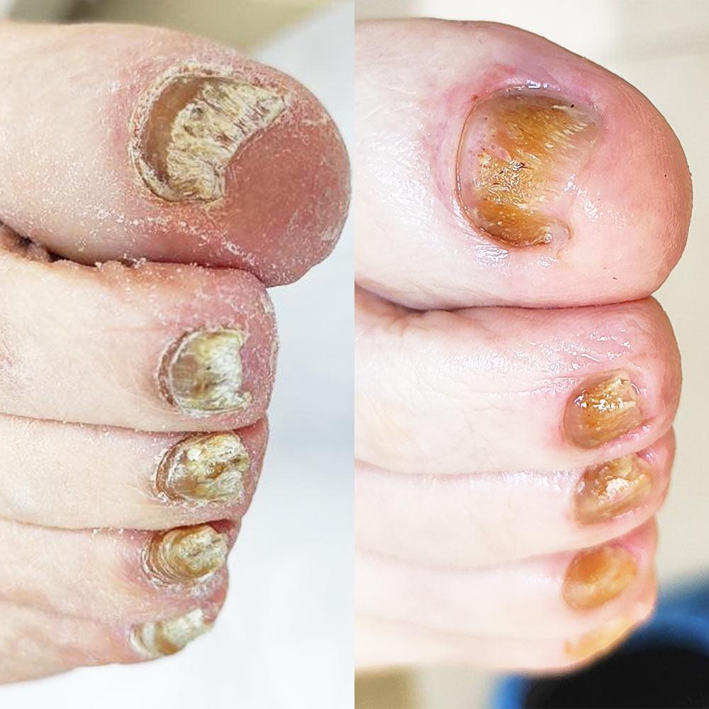 Обробка тотального дістрофічного оніхомікозу Київ