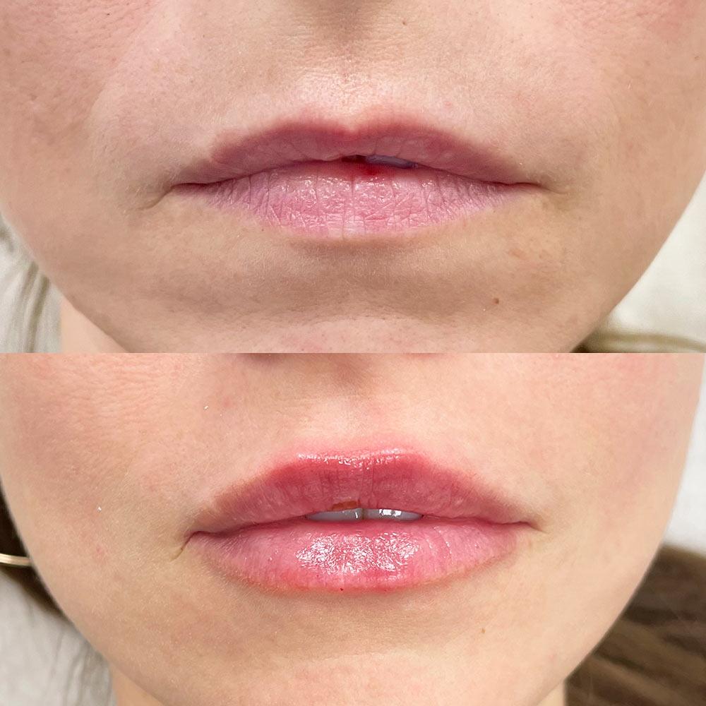 Контурная пластика губ Киев Контурная пластика губ Киев