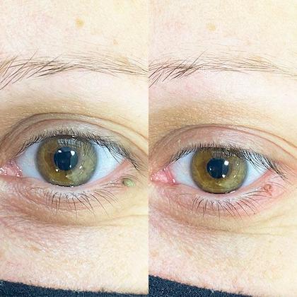 Видалення папіломи на повіці Київ Видалення папіломи на повіці Київ