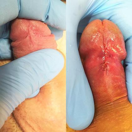 Пластика уздечки крайней плоти Киев