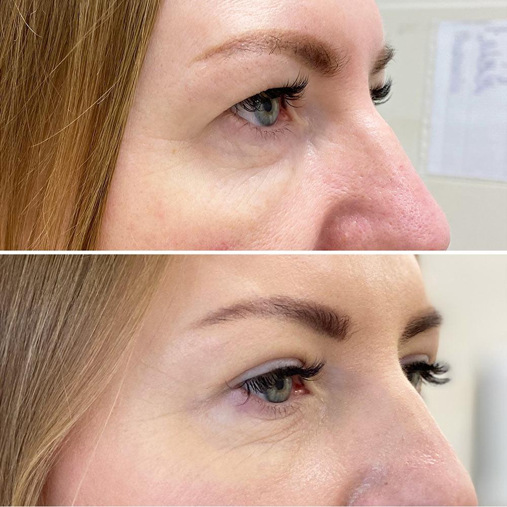 Верхняя блефаропластика Киев