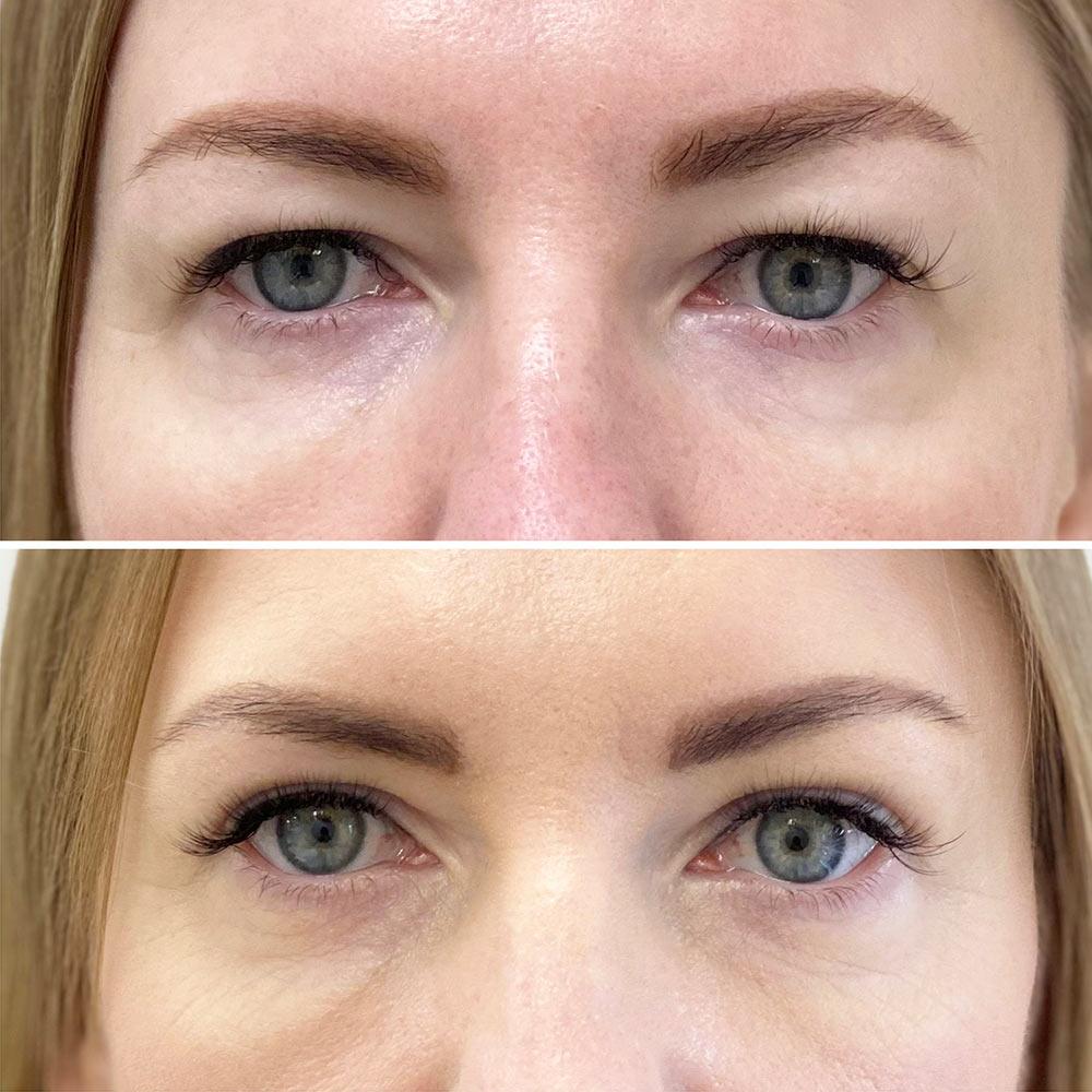 Верхняя блефаропластика Киев