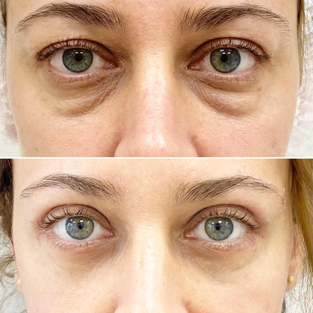 Кругова блефаропластика повік Київ