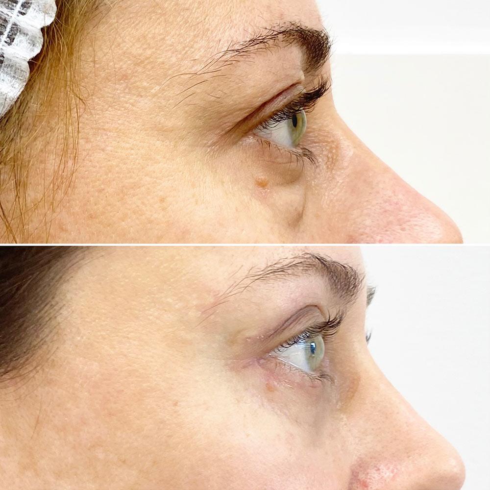 Кругова блефаропластика повік Київ