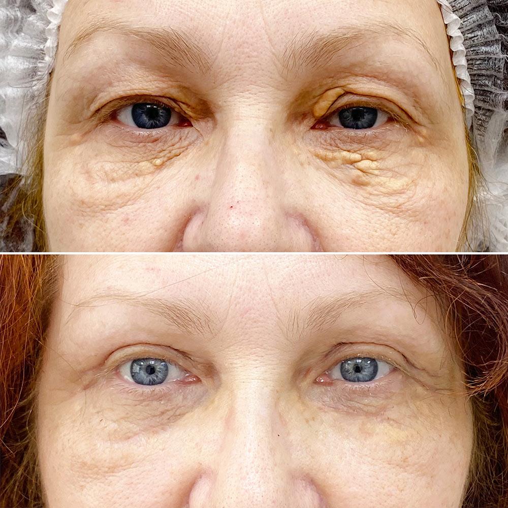 Видалення ксантелазм + Блефаропластика верхніх повік Київ