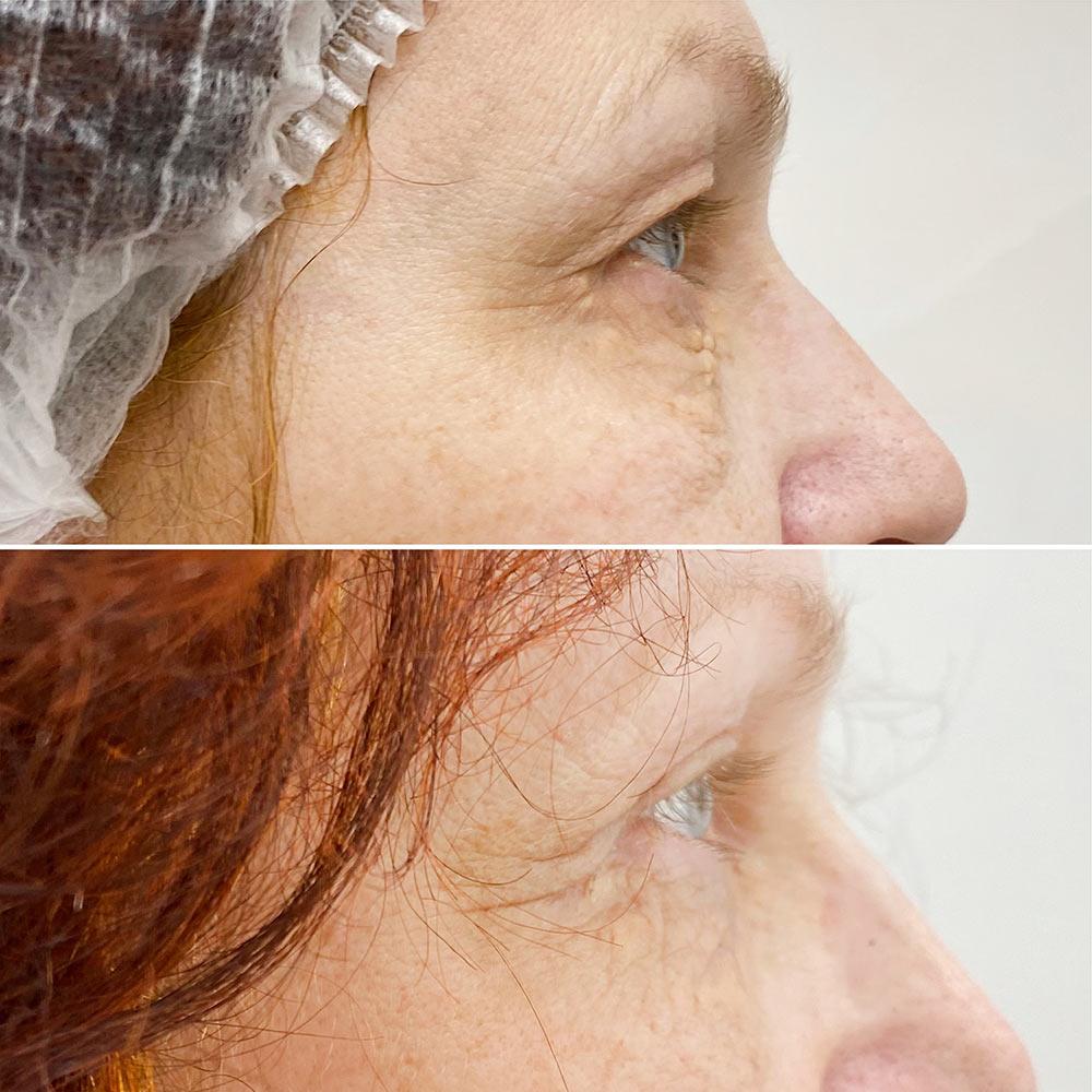 Верхня блефаропластика + видалення ксантелазм Київ