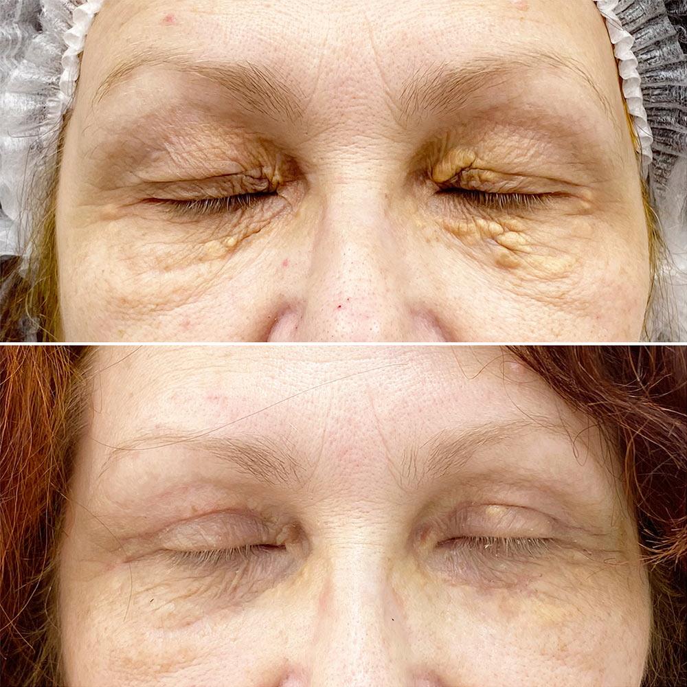 Видалення ксантелазм + Верхня блефаропластика Київ