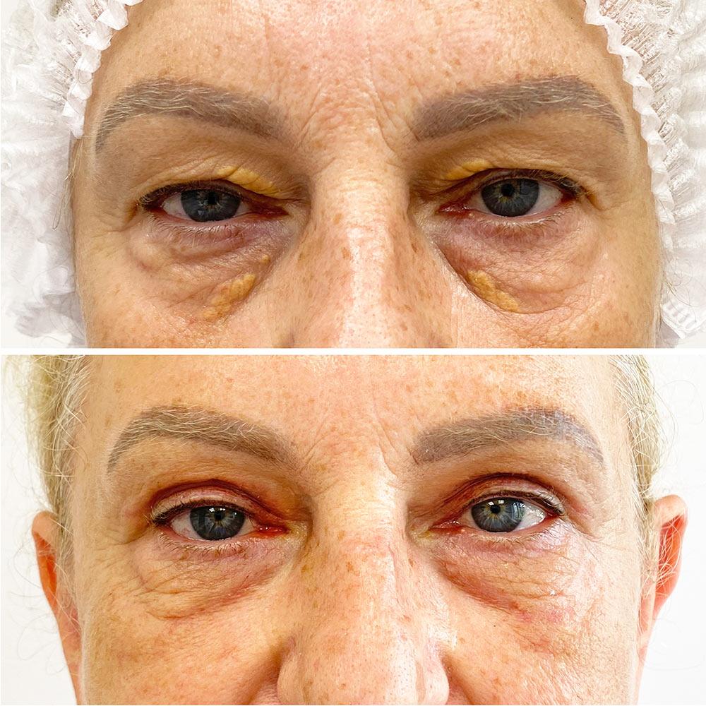 Хірургічне видалення ксантелазм + Блефаропластика повік Київ