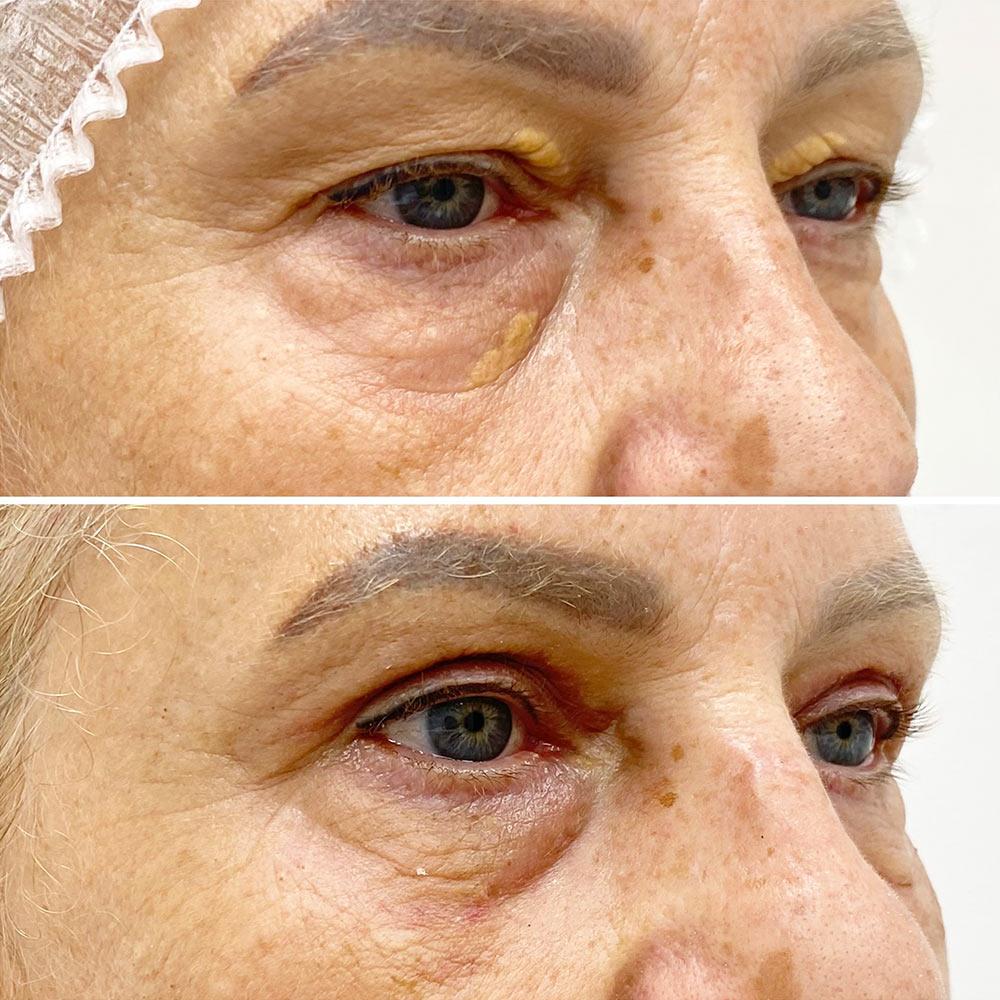 Блефаропластика верхніх повік + видалення ксантелазм Київ