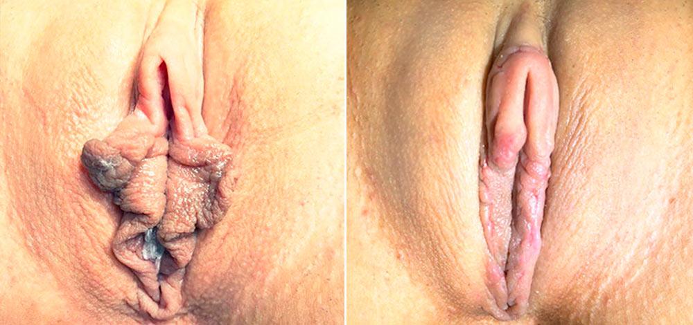 Лабіопластика малих статевих губ — до та після