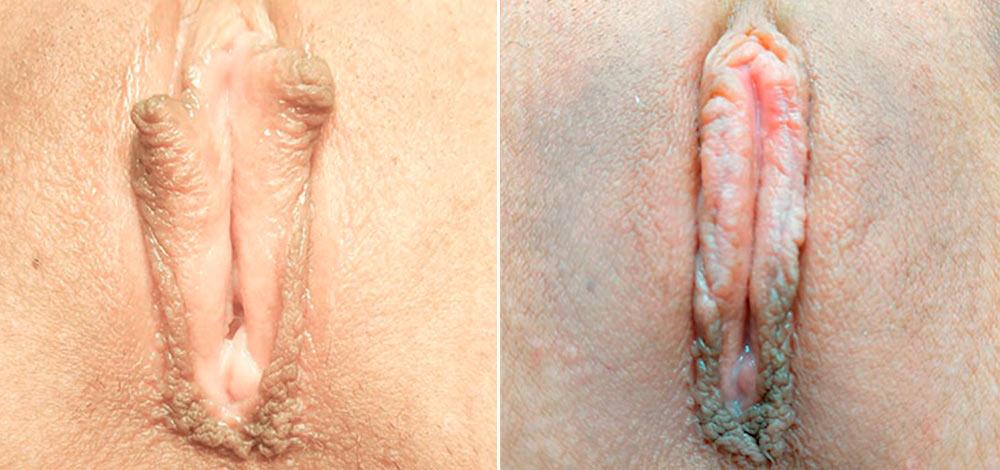 Корекція статевих губ до і після хірургічного втручання