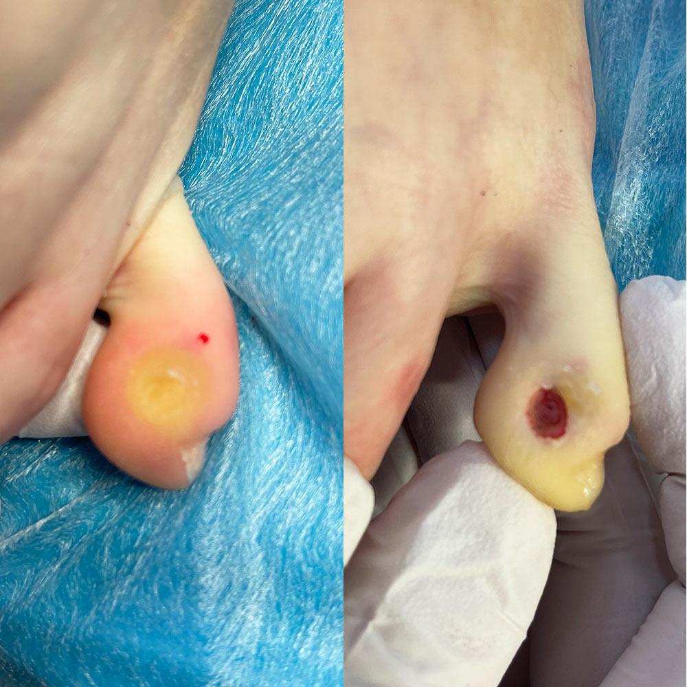 Лазерне видалення мозоля Київ