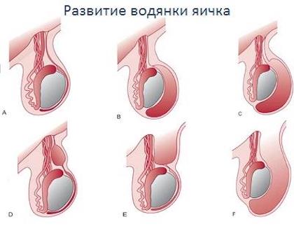 Развитие водянки яичка