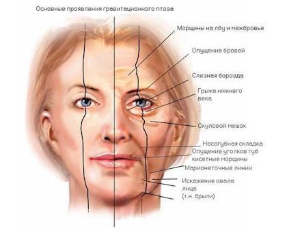 Підтяжка обличчя Підтяжка обличчя