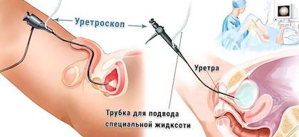 Цистоскопія Цистоскопія