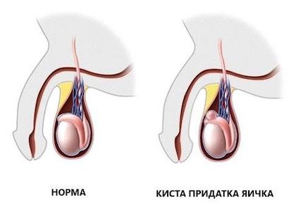 Киста придатка яичка