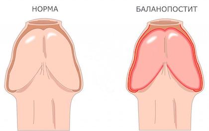 Баланопостит – лечение Баланопостита Киев