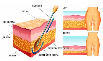 Ліпосакція тіла Київ Ліпосакція тіла Київ