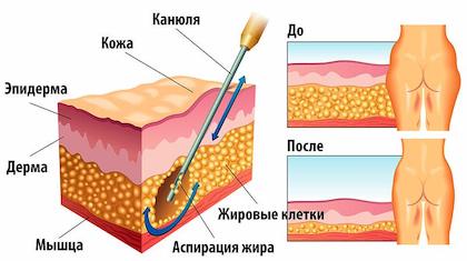 Липосакция тела Киев