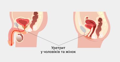 Уретрит